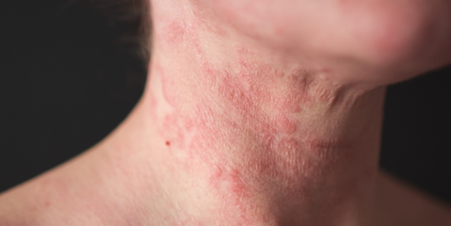 Atopic-dermatitis-eadv-congress-2026