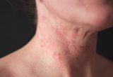 Atopic-dermatitis-eadv-congress-2026