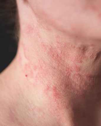 Atopic-dermatitis-eadv-congress-2026